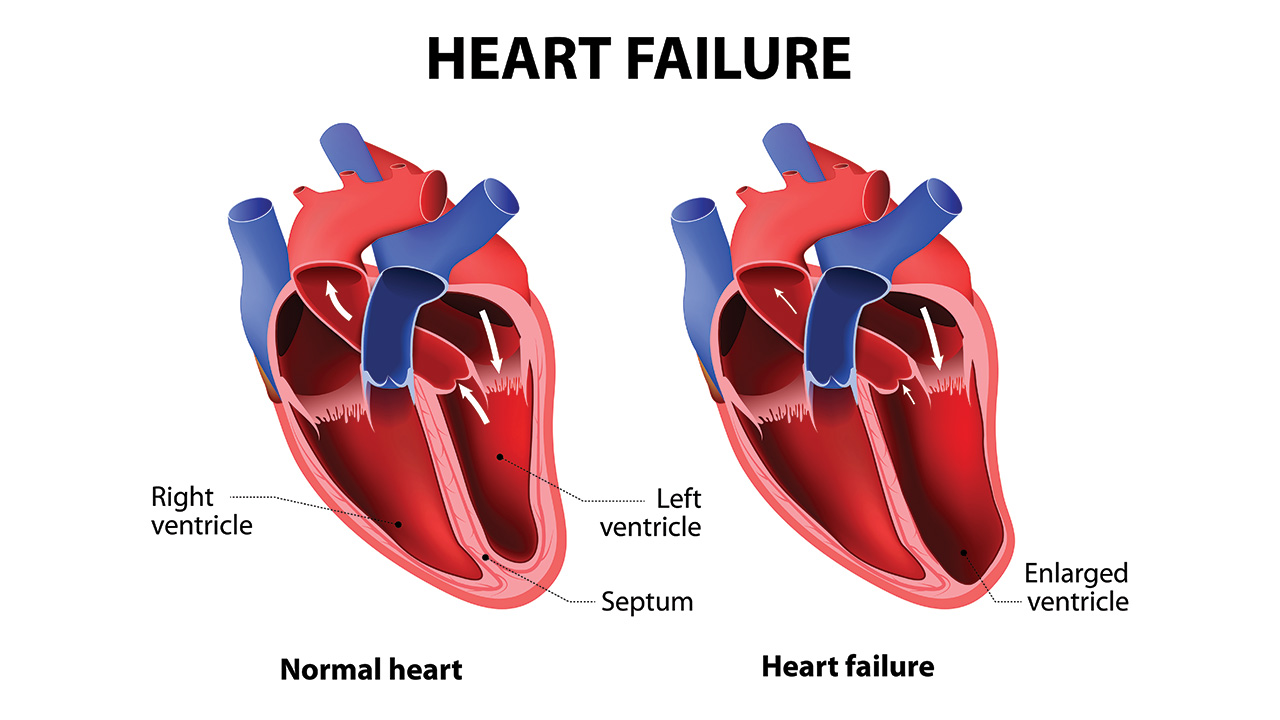 Heart failure is a medical condition in which t... main image