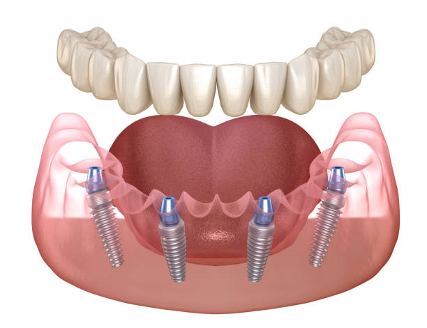 Transform Your Smile with Dental Implant Surgery a... main image