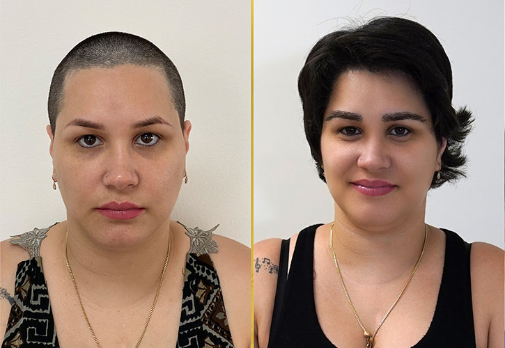 Decoding Hair Implants: ELORAA CLINIQ's Preferred ... main image