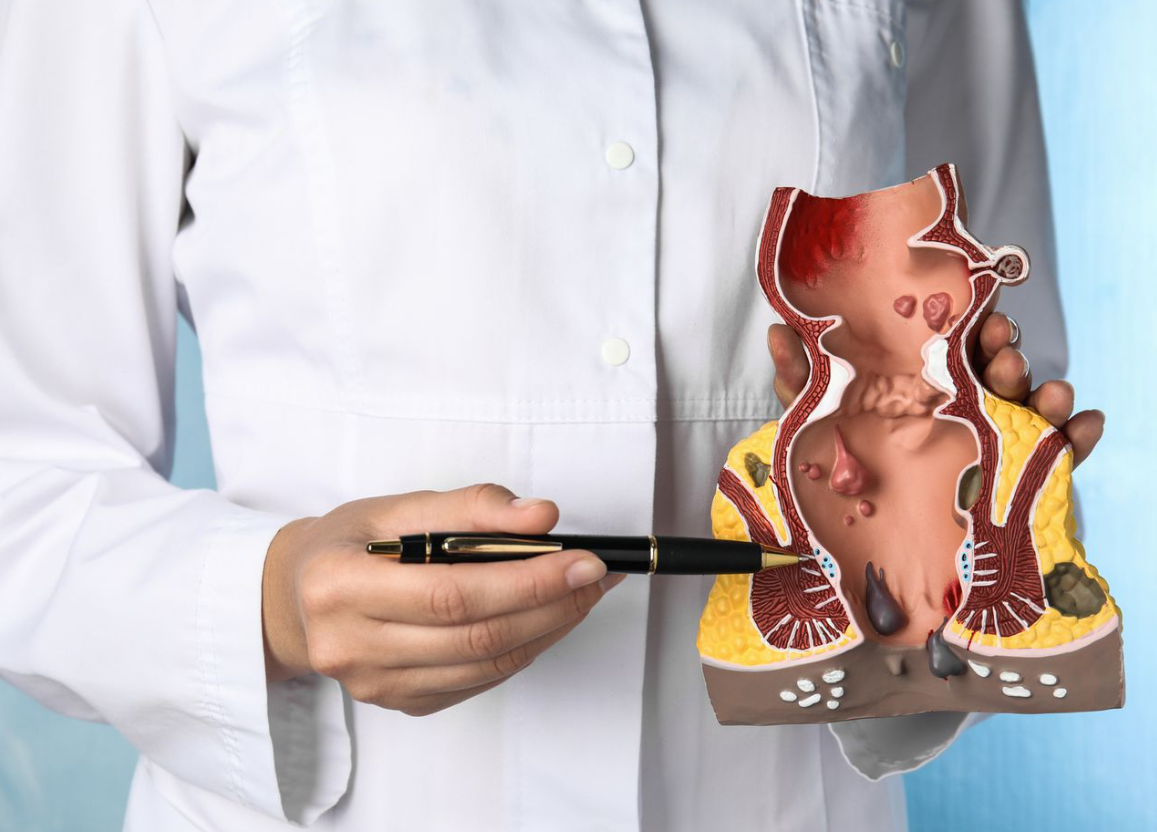 Fissure Treatment Excellence in Pune  Best... main image