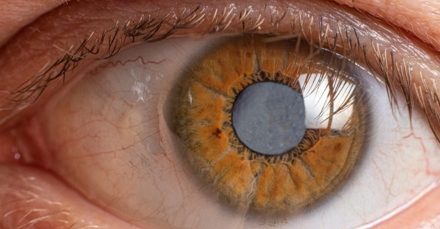Understanding Glaucoma: Causes, Symptoms, and Trea... main image