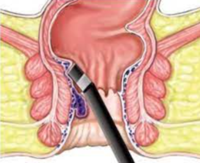 Laser Treatment Revolutionizing Piles Care Lase... main image