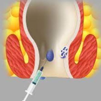 Injection Therapy: Effective Solution for Piles... main image