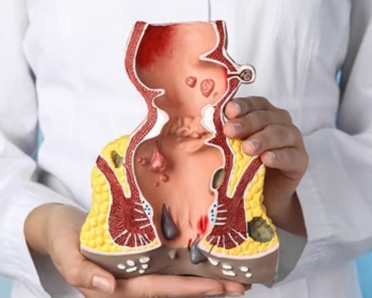 Best Piles Surgeon Near Me - Dr. Rajiv Manek's ... main image