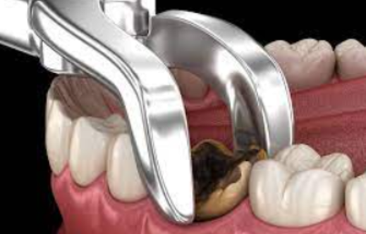 Comprehensive Tooth Extraction Procedure at Dr. Ra... main image