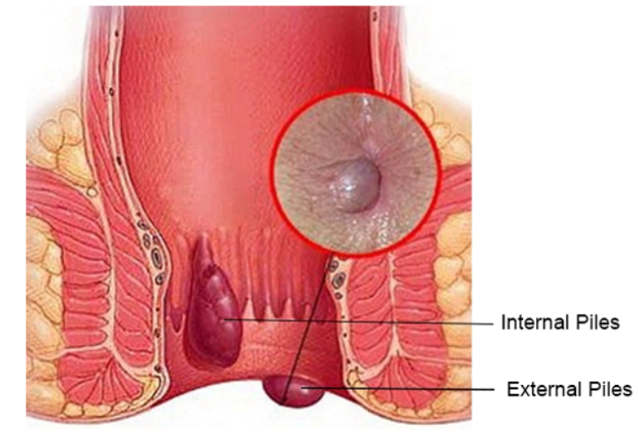 Holistic Approach to Piles Care: Diet and Lifes... main image