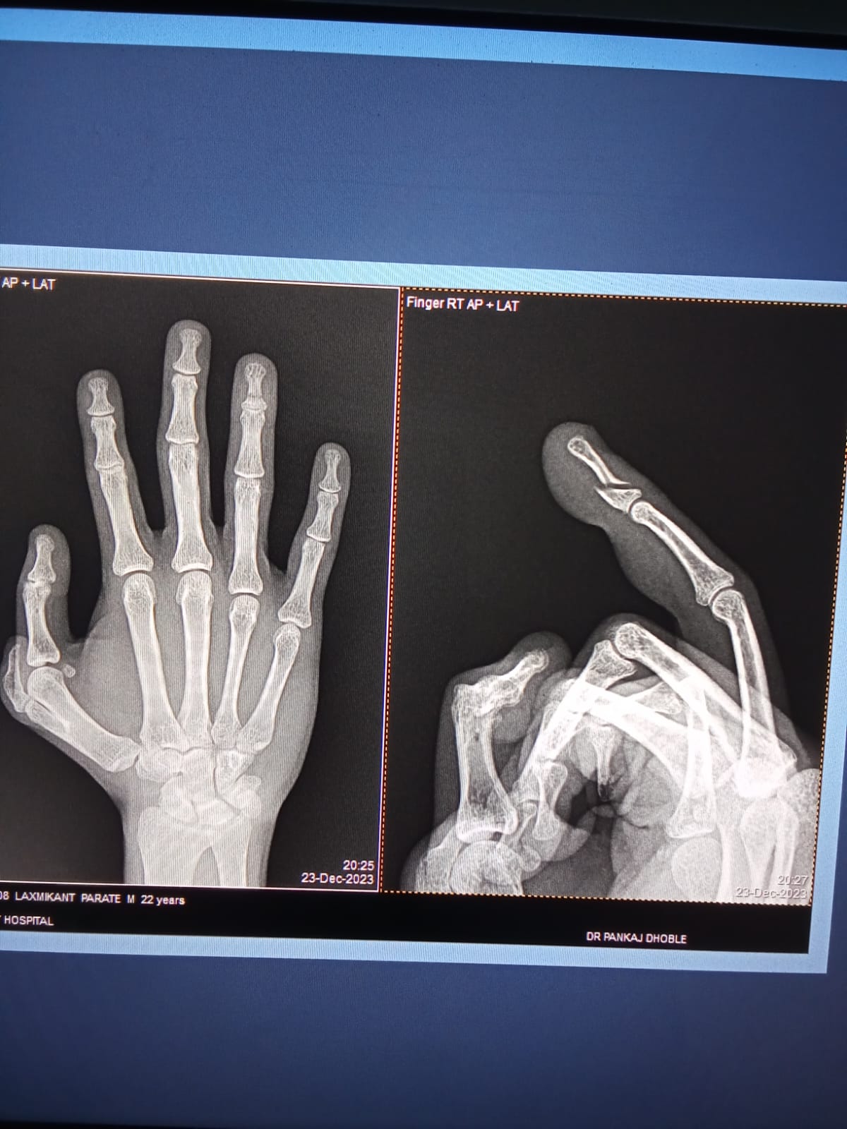 Types of Fractures: Finger fractures can vary in s... main image