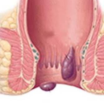 Ayurvedic Solutions for Piles: Natural Healing ... main image