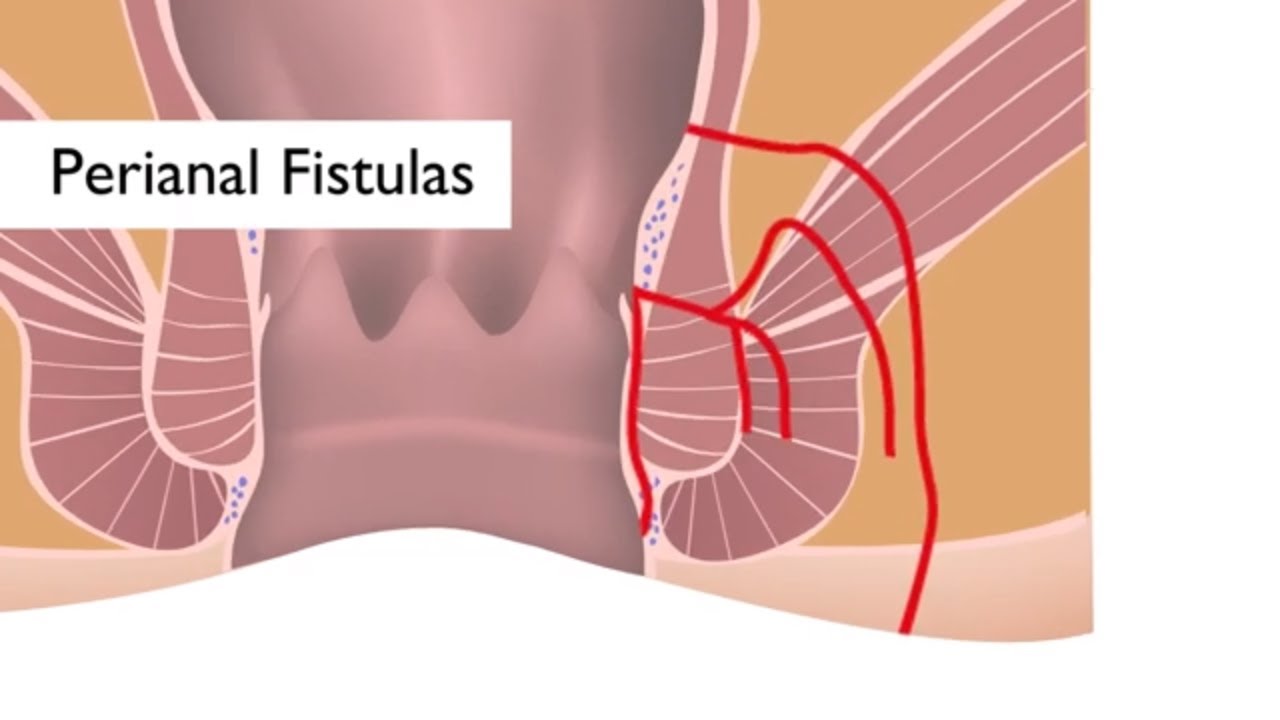 Best Treatment For Fistula In Pune Maharashtra
... main image