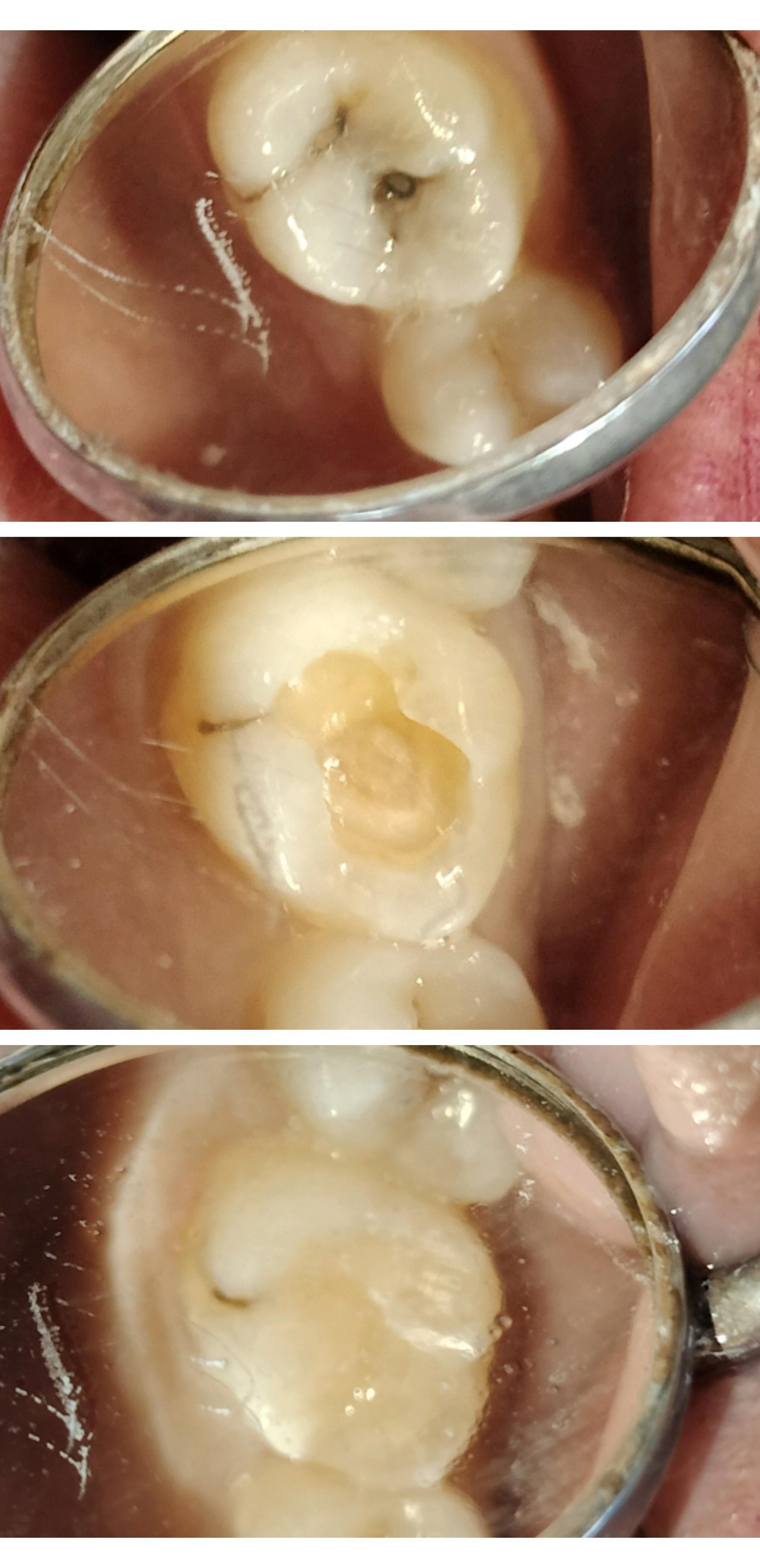 #tooth colored filling. #composite filling #cos... main image