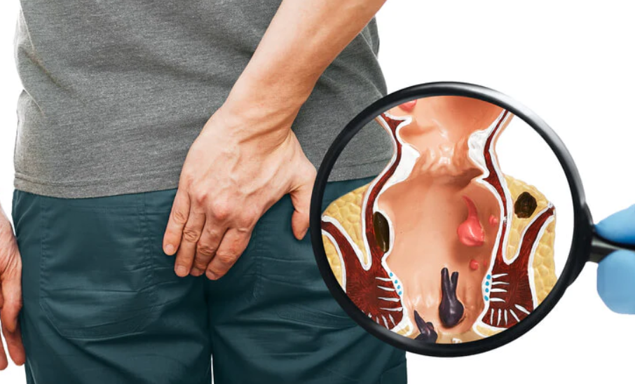 Preventing Piles: Tips for a Healthy Lifestyle ... main image