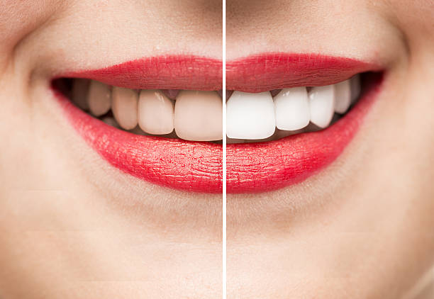 Teeth whitening Process Dent-O-Facial Dr. Priye... main image