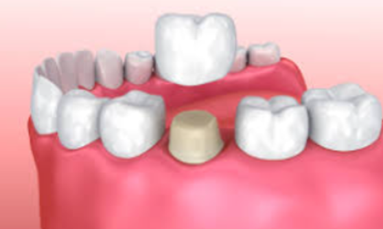 Restore Your Smile with Dental Cap Treatments at D... main image
