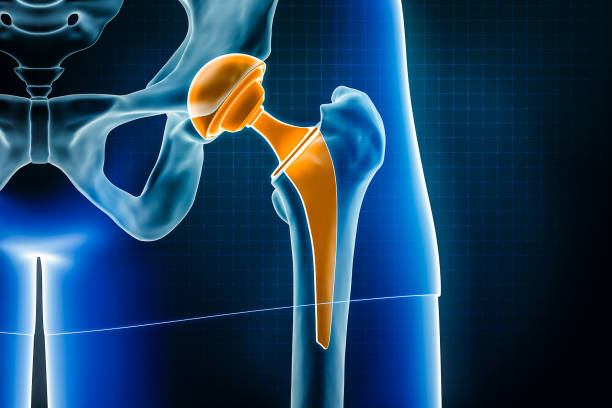 Hip Joint Replacement: Restoring Functionality ... main image