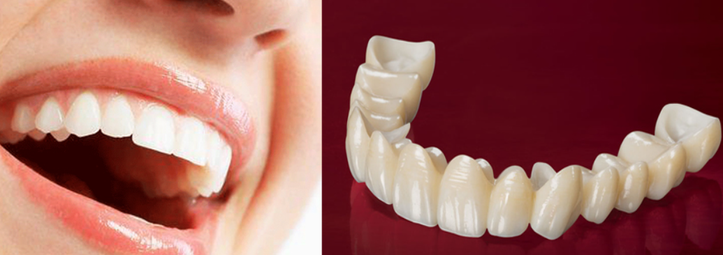 Opt for Zirconia Cap Treatments for Durability and... main image