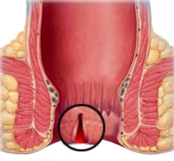 Understanding Fissures: Treatment Options and P... main image