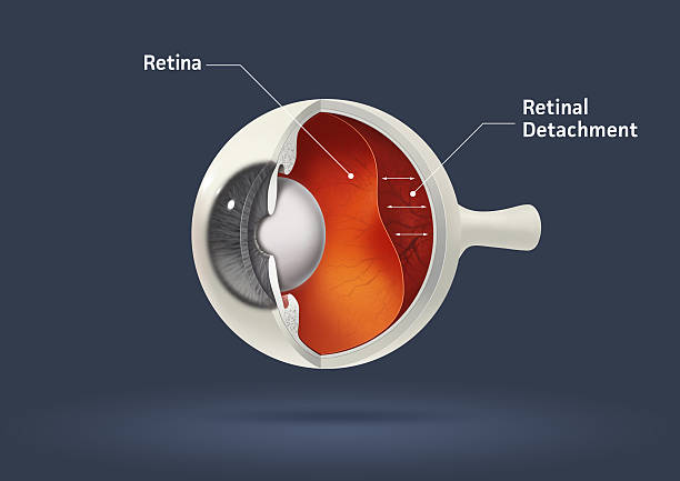 The Best Detached Retina Treatment Near Me: Ish... main image