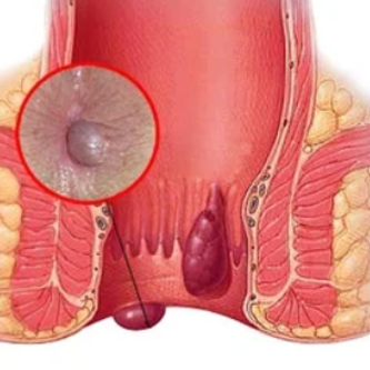 Comprehensive Piles Treatment at Dr. Phapale Ho... main image
