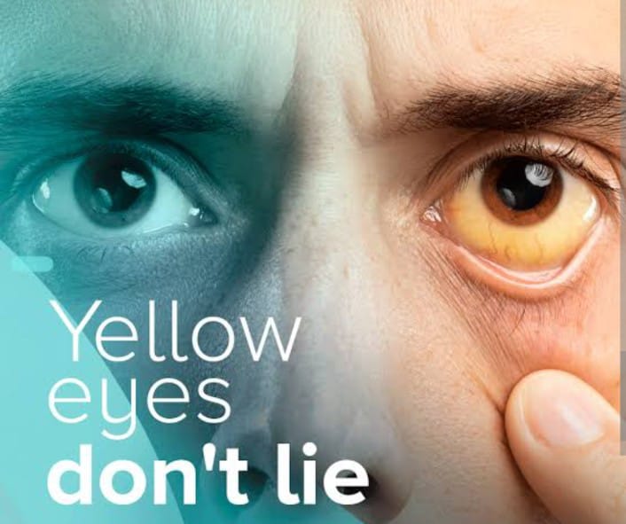 Jaundice is a medical condition characterized by t... main image