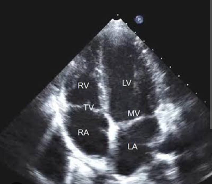 Echocardiography is a non-invasive diagnostic i... main image