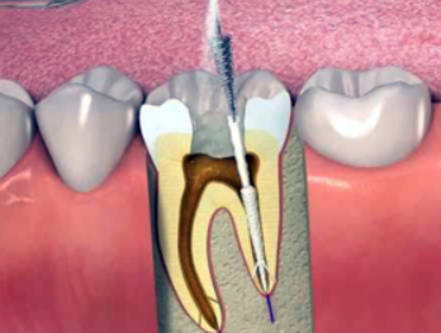 Painless RCT: The Key to Stress-Free Root Canal Tr... main image