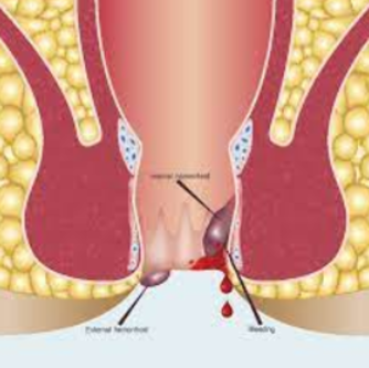 Stay Healthy with Dr. Phapale Hospital's Piles ... main image