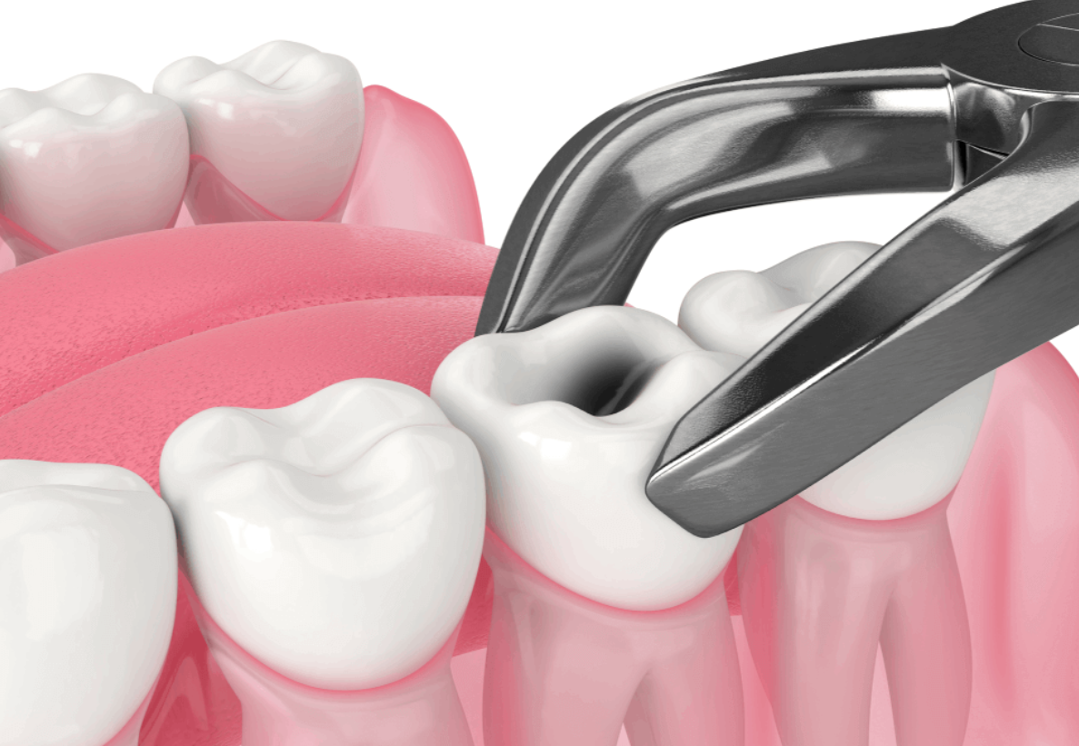 Tooth Extraction Procedure: Expert Care at Dr. Rai... main image