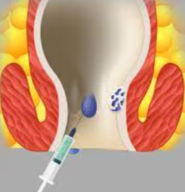 Effective Injection Therapy for Piles at Dr. Ph... main image