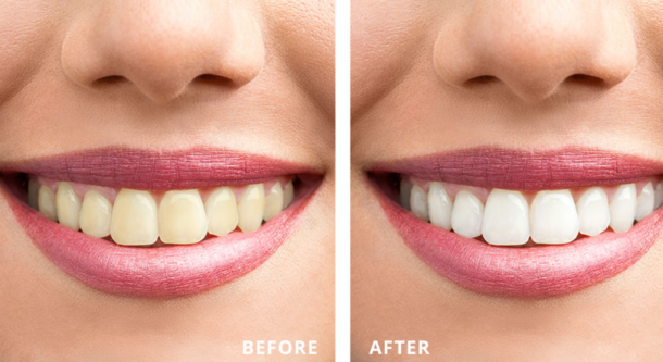 Teeth Whitening Process: Brighten Your Smile with ... main image