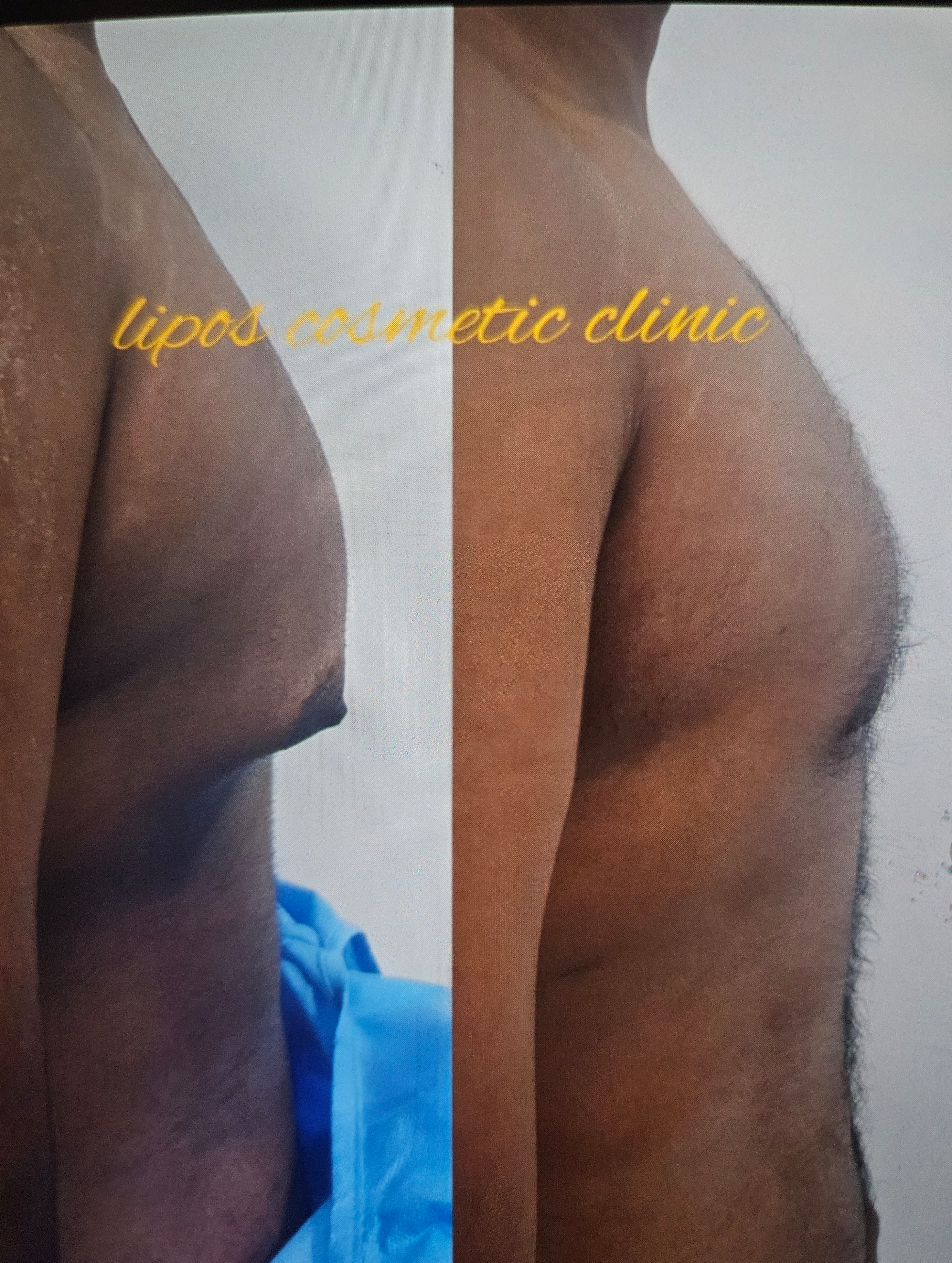 Gynecomastia (guy-nuh-koh-MAS-tee-uh)/male brea... main image