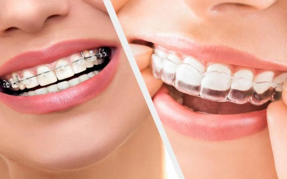 Braces Treatments: Achieve Your Dream Smile with P... main image