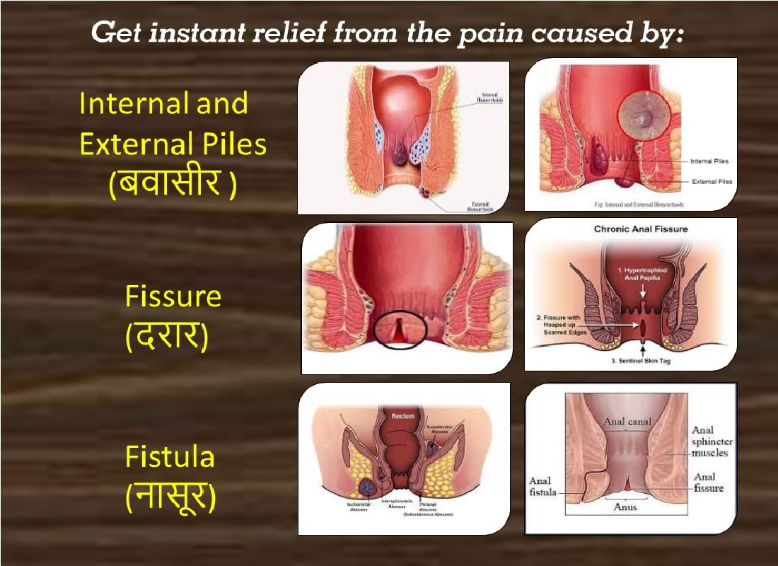 #BestDoctorForPilesFistulaFissureInDhayariWadga... main image