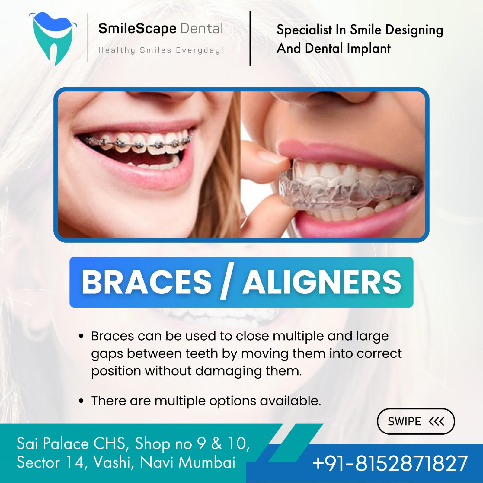 Conscious of spaces between your teeth? ✨
Bridg... main image