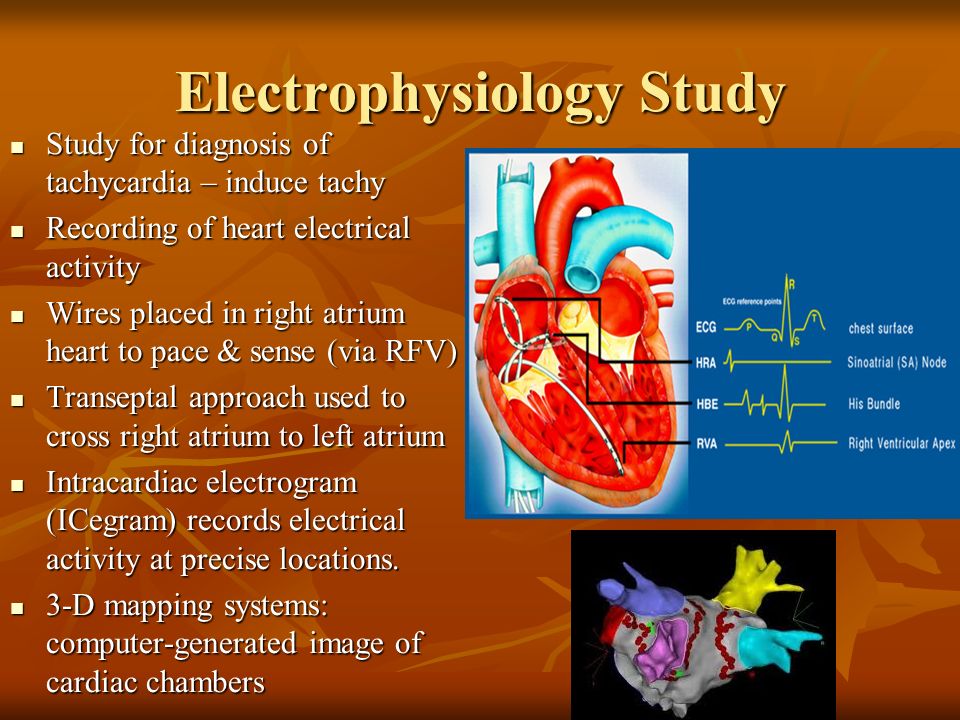 Electrophysiology Study (EPS):

An electrophysi... main image