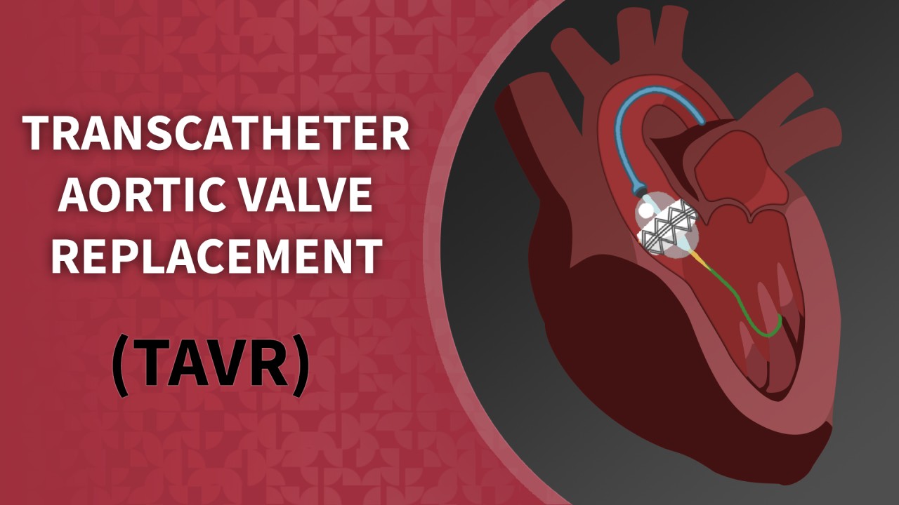 Transcutaneous Aortic Valve Replacement (TAVR),... main image