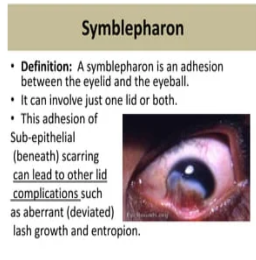 Restore Comfort and Vision: Treating Symblepharon ... main image