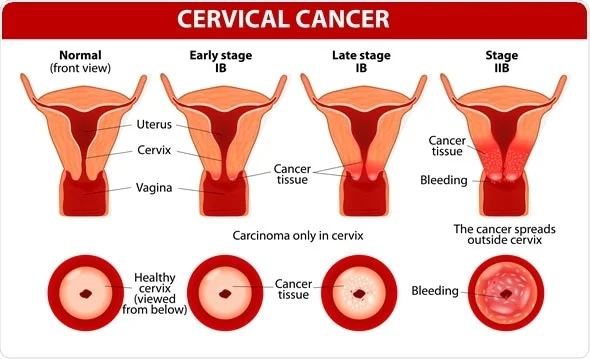 Cervical cancer occurs when cells in the cervix... main image