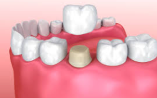 Dental Cap Treatments: Enhance Your Smile's Streng... main image