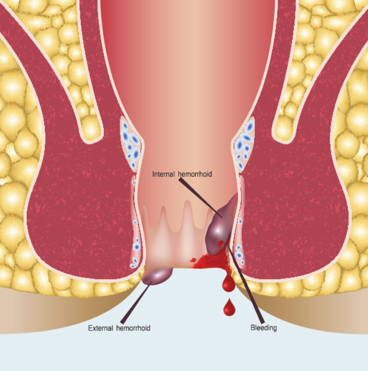 Stay Informed: Recognizing Early Signs of Piles... main image