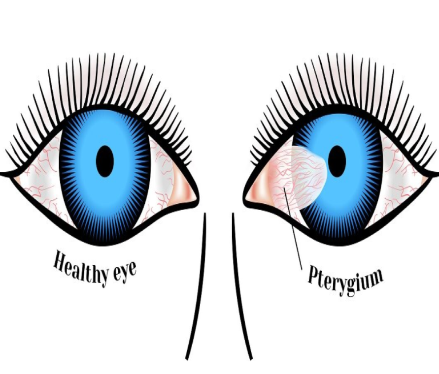 Say Goodbye to Pterygium: Expert Treatment at Gree... main image