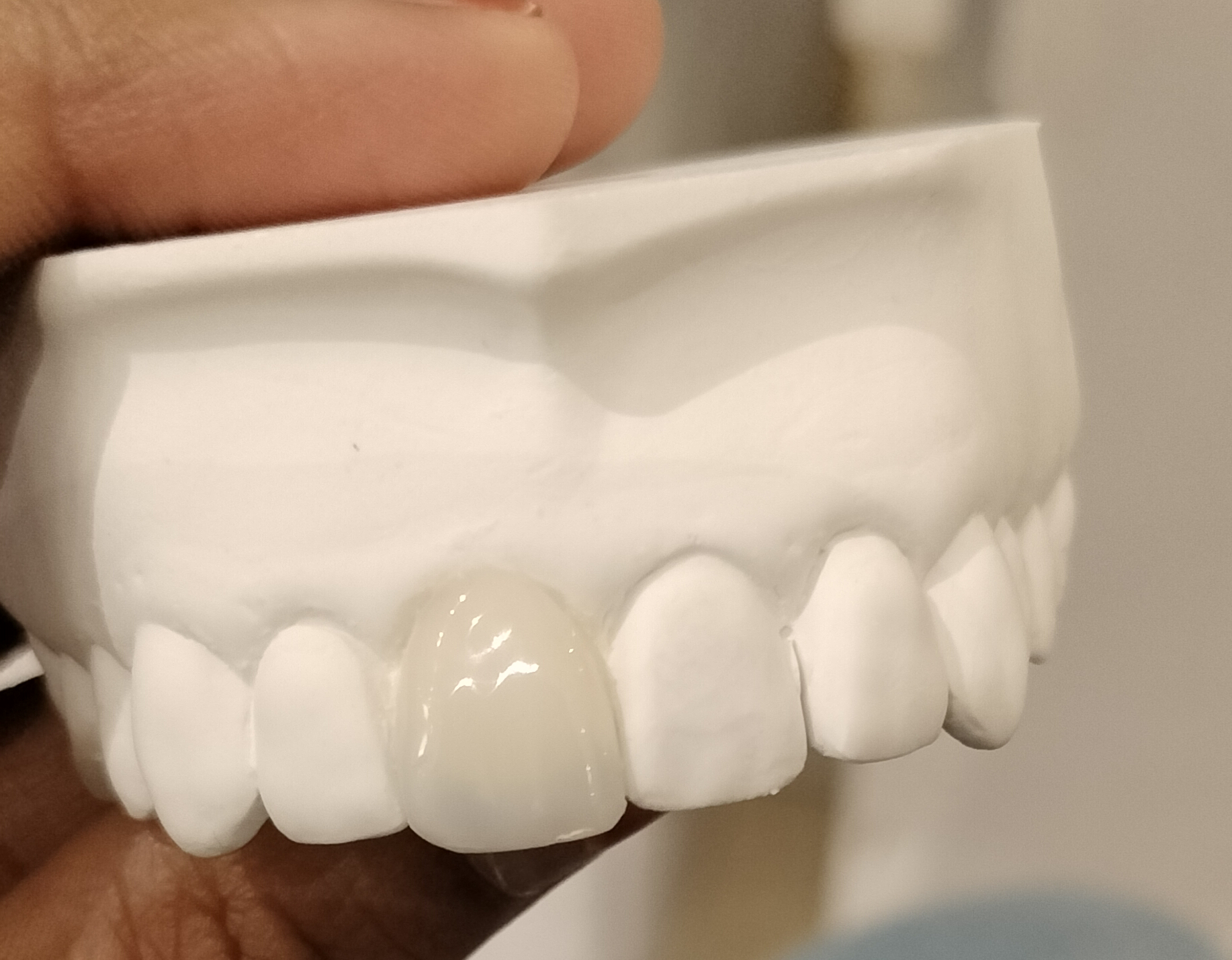 #toothcoloredcap #aestheticcapinmiraroad #smiledes... main image