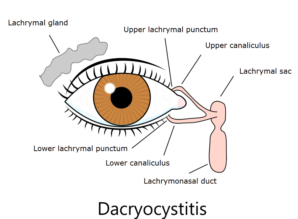 Relief from Dacryocystitis: Specialized Care at... main image