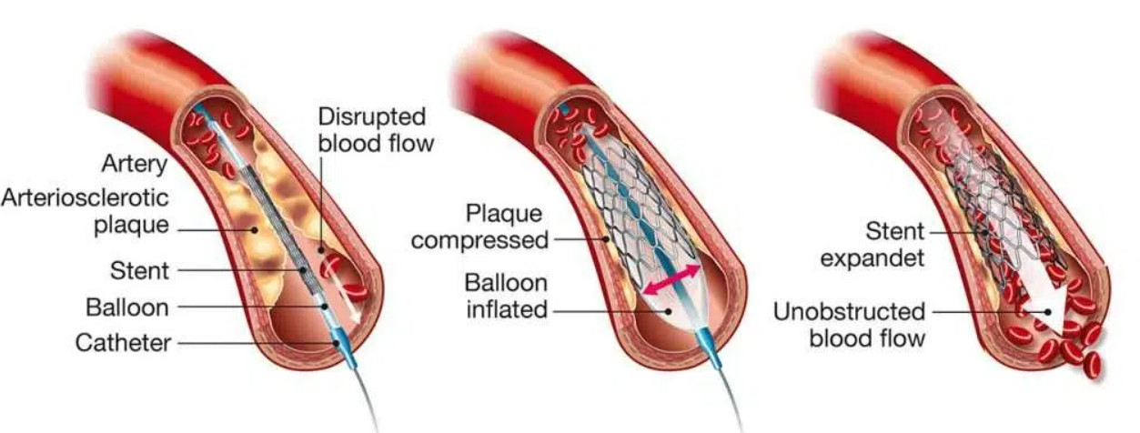 Leading Angiography and Angioplasty Services at Me... main image