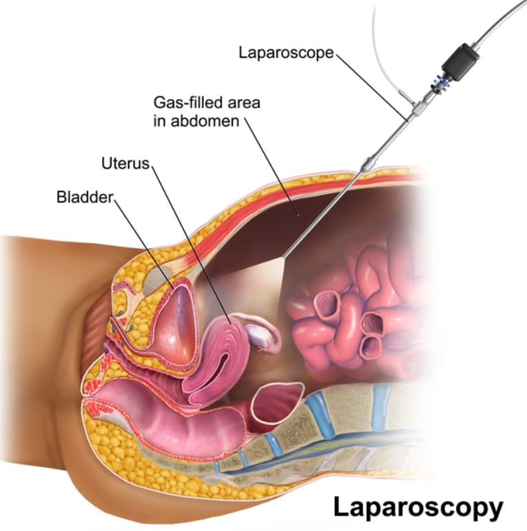Laparoscopic Surgeri