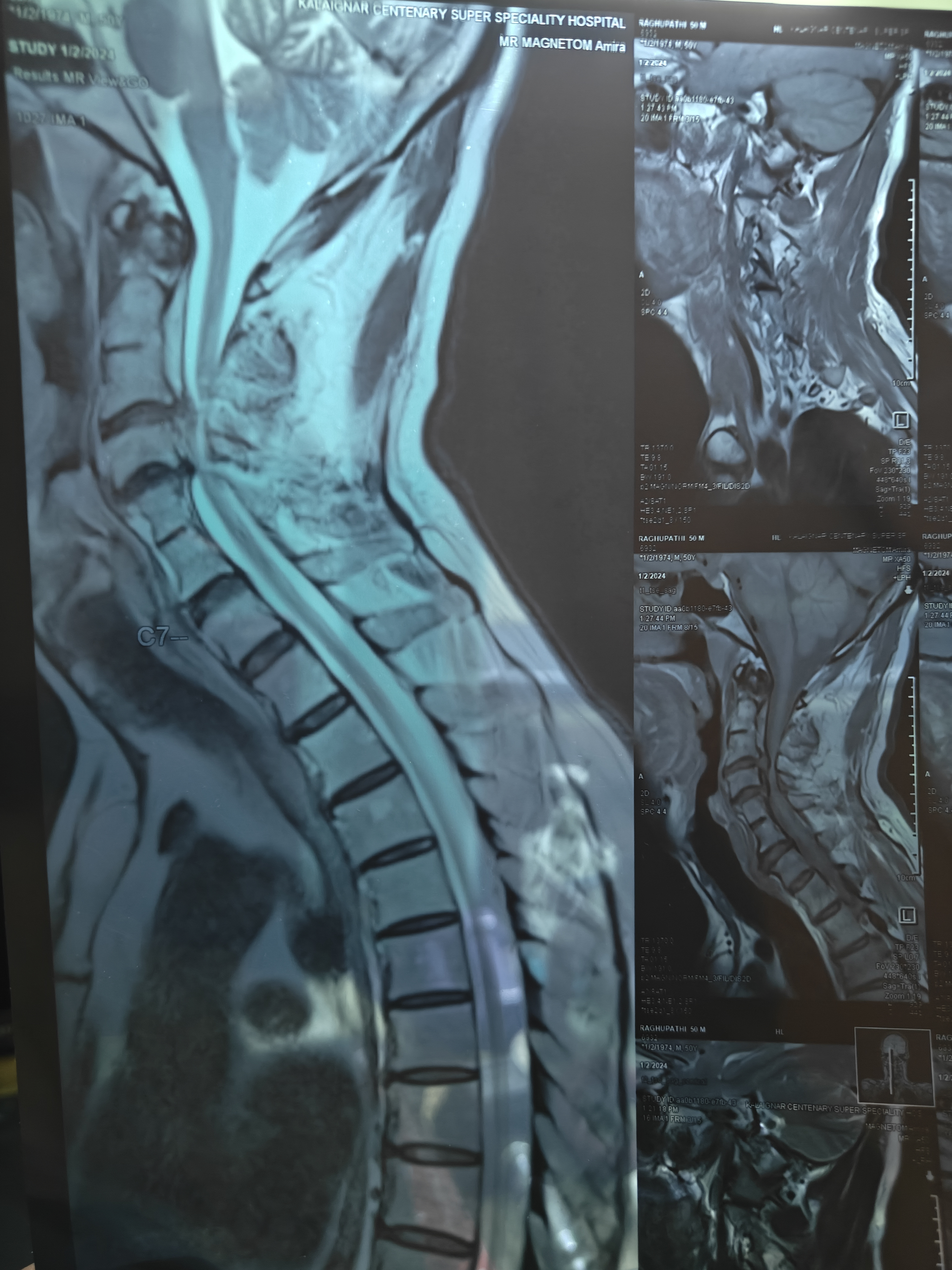 6 Months old case of cervical disc extrusion of C3... main image