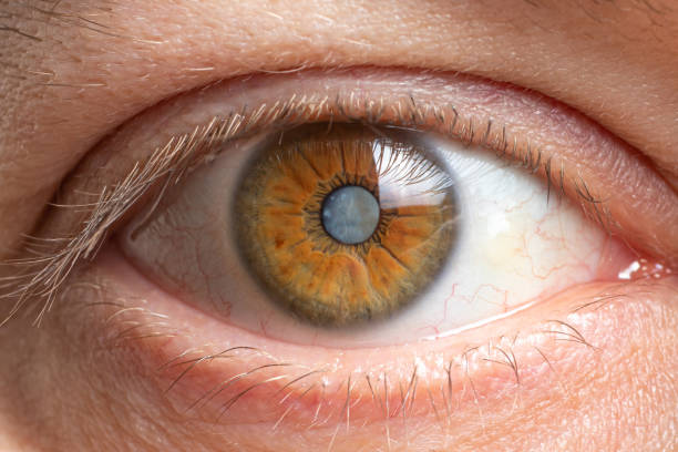 Personalized Catarac