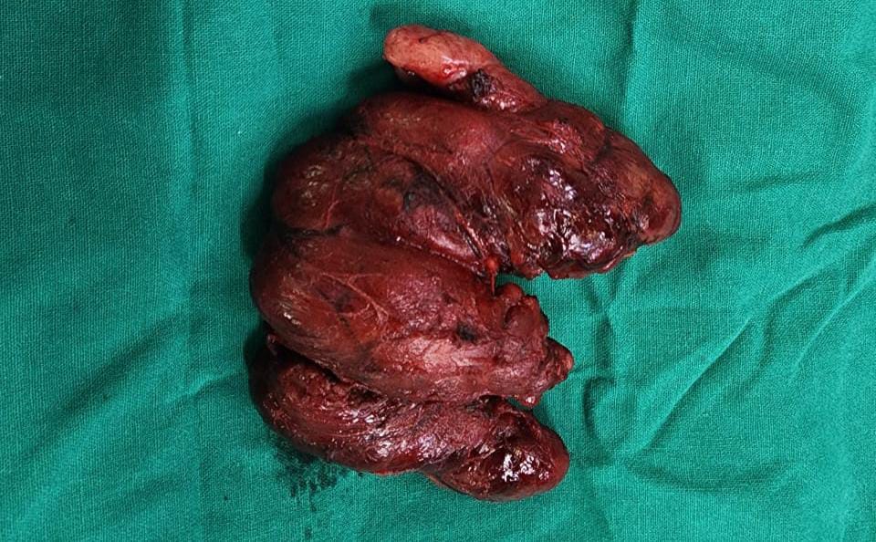 TODAYS MAJOR SURGERY- THYROIDECTOMY.
#otcase #h... main image