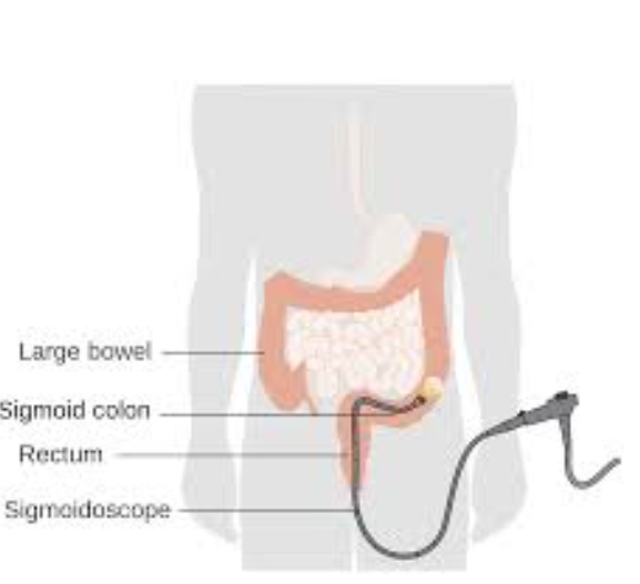 Navigating Digestive Health: Sigmoidoscopy at D... main image