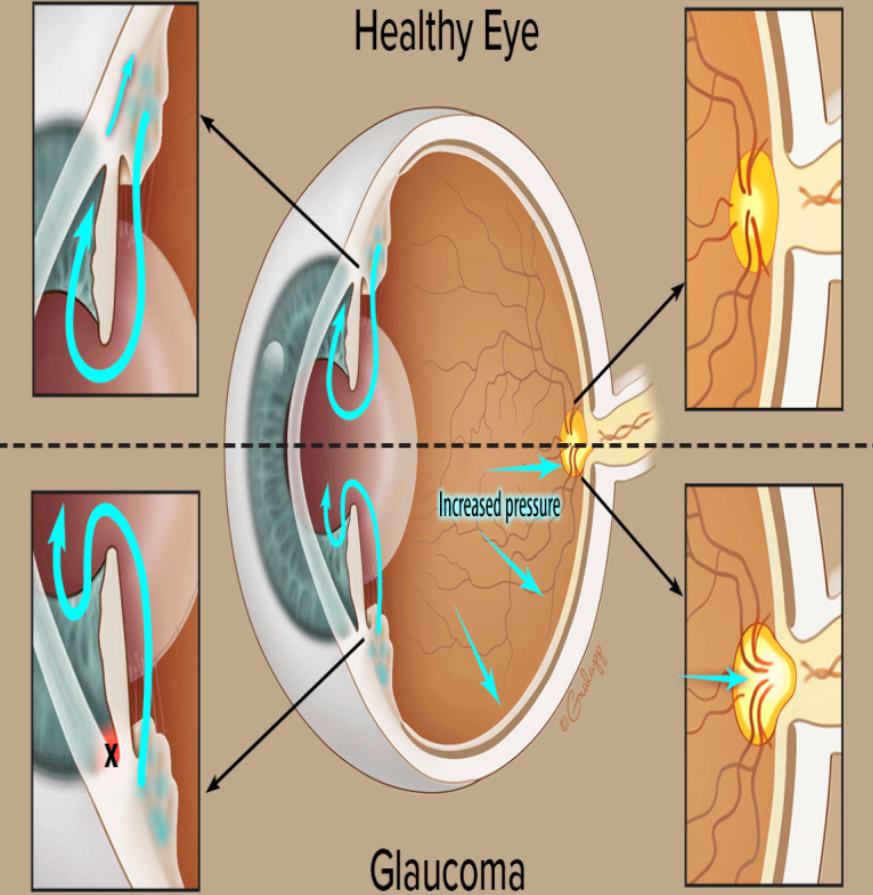 Preventing Vision Loss: Expert Care for Glaucom... main image