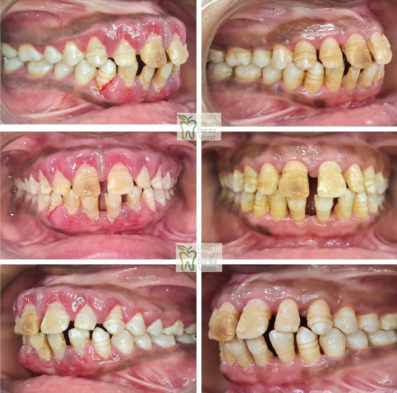 GUMS are the supporting pillars of teeth. Gum d... main image